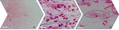 The value of biofilm testing to guide antimicrobial stewardship in chronic respiratory diseases